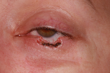 Pre-op left lower eyelid Mohs' defect