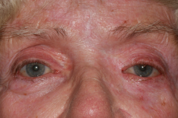 Post-op left medial canthus 1 year after repair