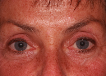 Female post-op blepharoplasty and brow lift with improved lid and brow position