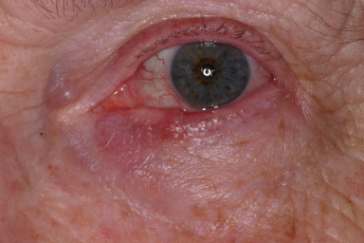 Pre-op basal cell carcinoma left lower eyelid