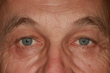 Male post-op brow lift with improved brow height