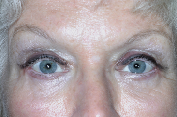 Female post-op ptosis with improved eyelid height