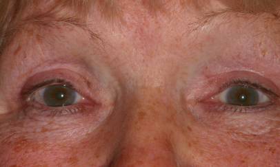Female post-op ptosis with improved eyelid height