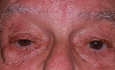 Male pre-op ptosis and blepharoplasty with excess upper eyelid skin and drooping eyelids as well as lower eyelid fullness