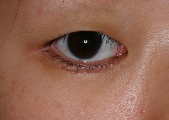 Female post-op epiblepharon right lower eyelid with improved lash position