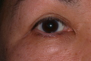 Post-op epiblepharon surgery with improved right lower eyelid position