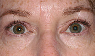 Female pre-op brow lift and blepharoplasty with excess upper eyelid skin