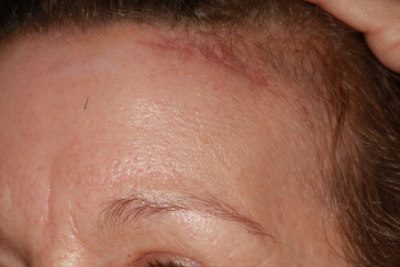 Post-op Left Side Pretrichial Scar