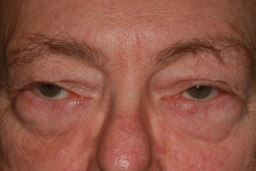 Male pre-op ptosis with drooping eyelids