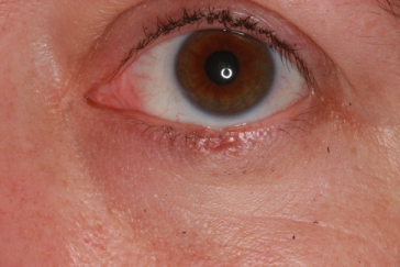 Pre-op basal cell carcinoma left lower eyelid