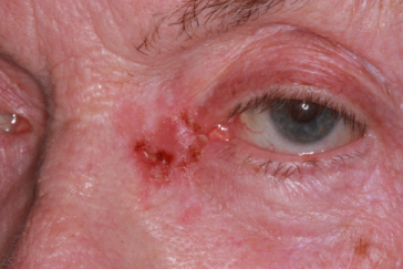 Pre-op squamous cell carcinoma left medial canthus