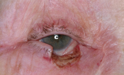 Wedge defect right lower eyelid