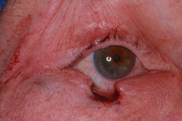 Right lower eyelid wedge defect