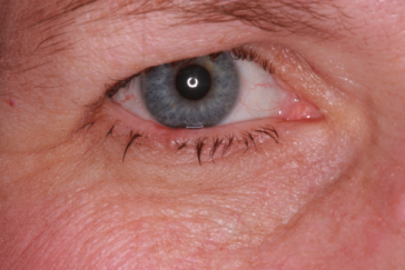 Pre-op basal cell carcinoma right lower eyelid