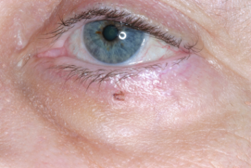 Pre-op basal cell carcinoma left lower eyelid