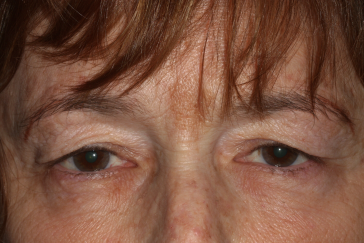 Female pre-op blepharoplasty and brow lift with excess upper eyelid skin and heavy brows