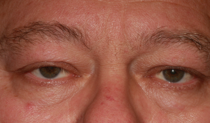 Male pre-op ptosis and blepharoplasty with excess upper eyelid skin and drooping eyelids as well as lower eyelid fullness