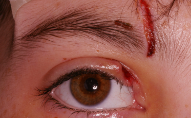 Pre-op laceration right upper eyelid and brow