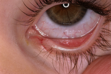 Before repair showing notch in tear duct