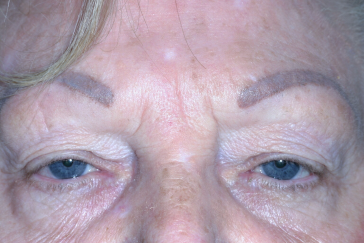 Female pre-op ptosis and blepharoplasty with drooping eyelids and excess skin