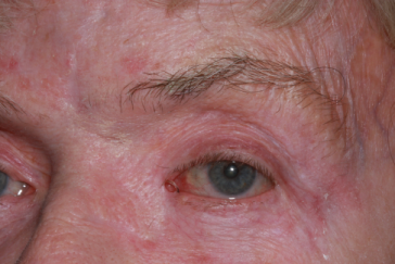 Post-op 9 months after reconstruction with stent left lower eyelid